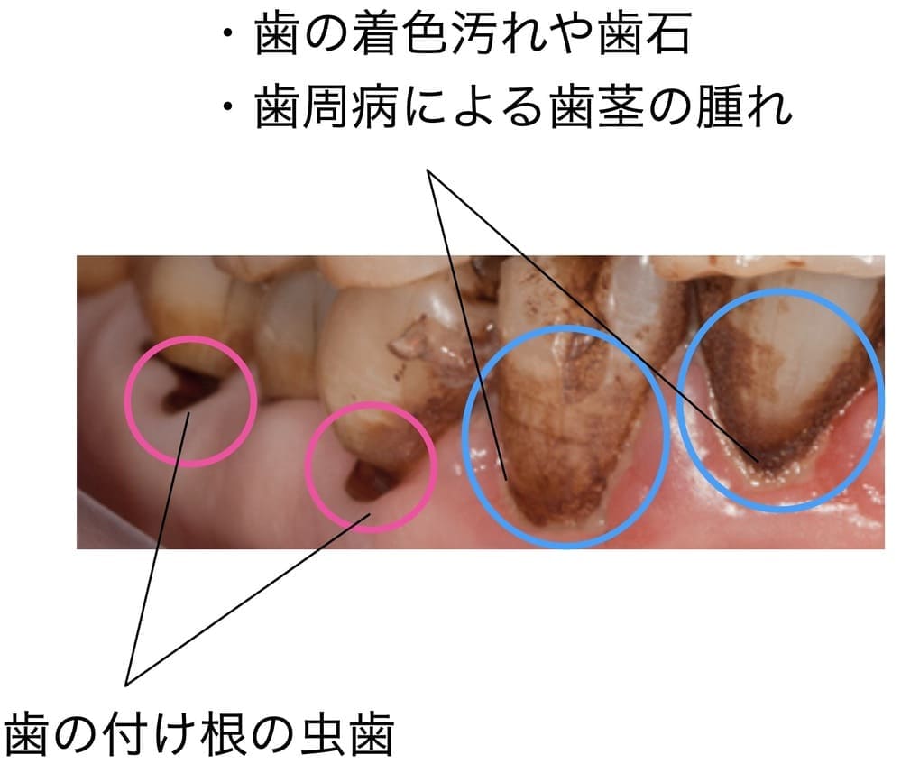 歯の付け根の虫歯と着色汚れ