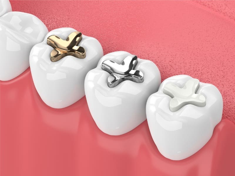 銀歯とセラミックの詰め物の比較画像