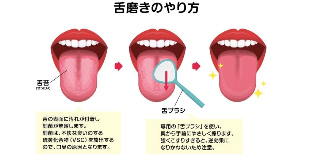 舌苔の取り方（舌磨き）の画像