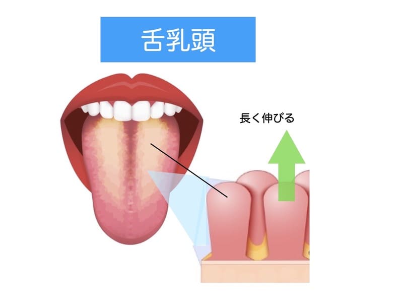 舌乳頭の伸長により、舌が白くなった画像