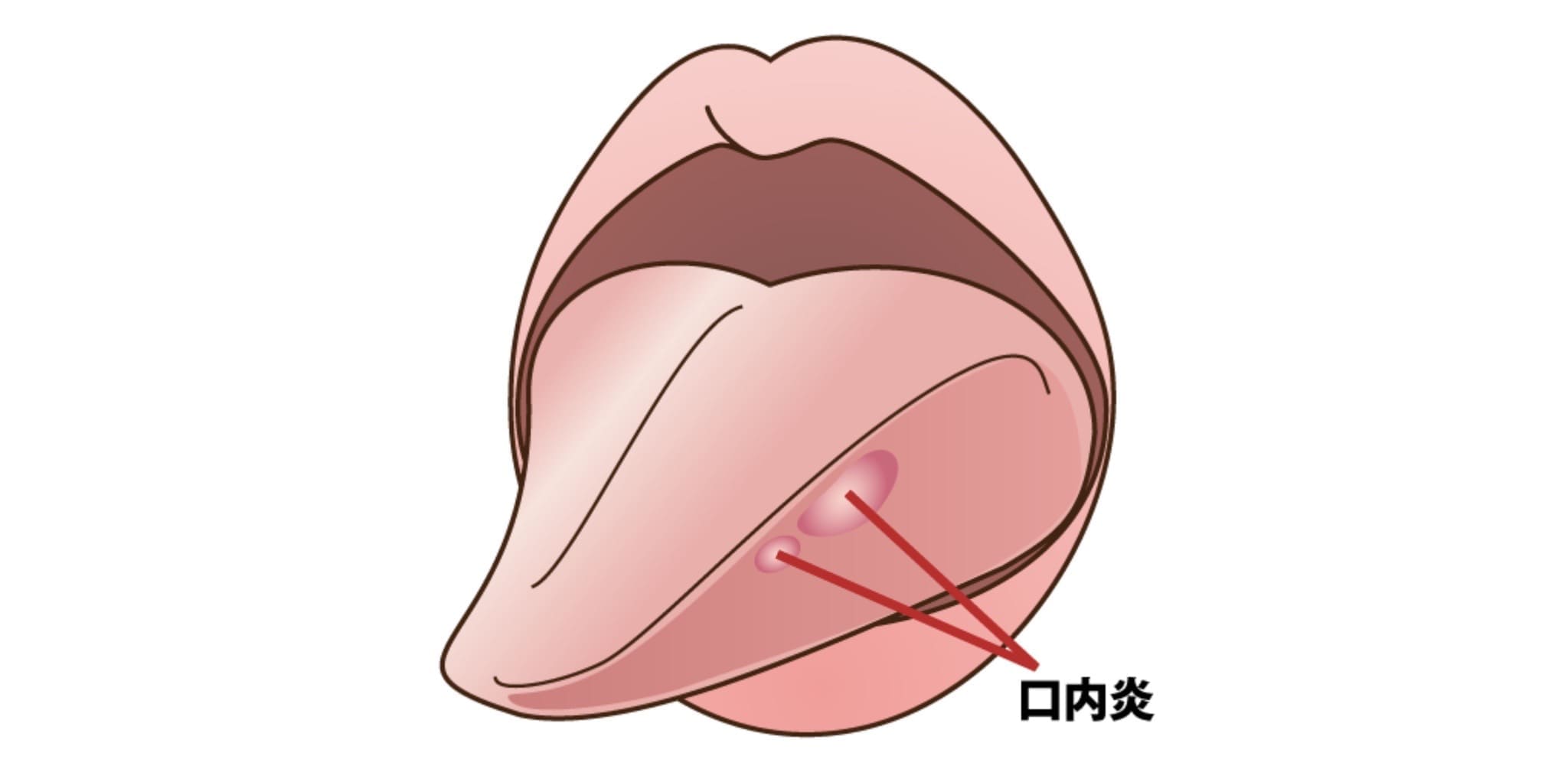 口内炎の画像