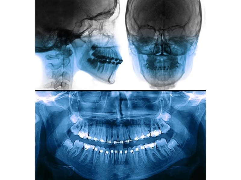 歯科矯正のレントゲン画像