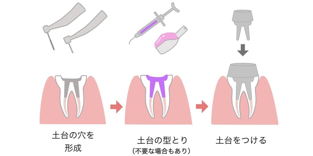 歯の土台作りの工程を示す画像