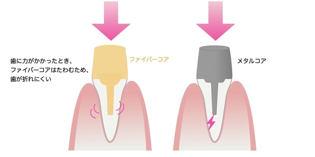 ファイバーコアが歯根破折防止になる仕組みを示す画像