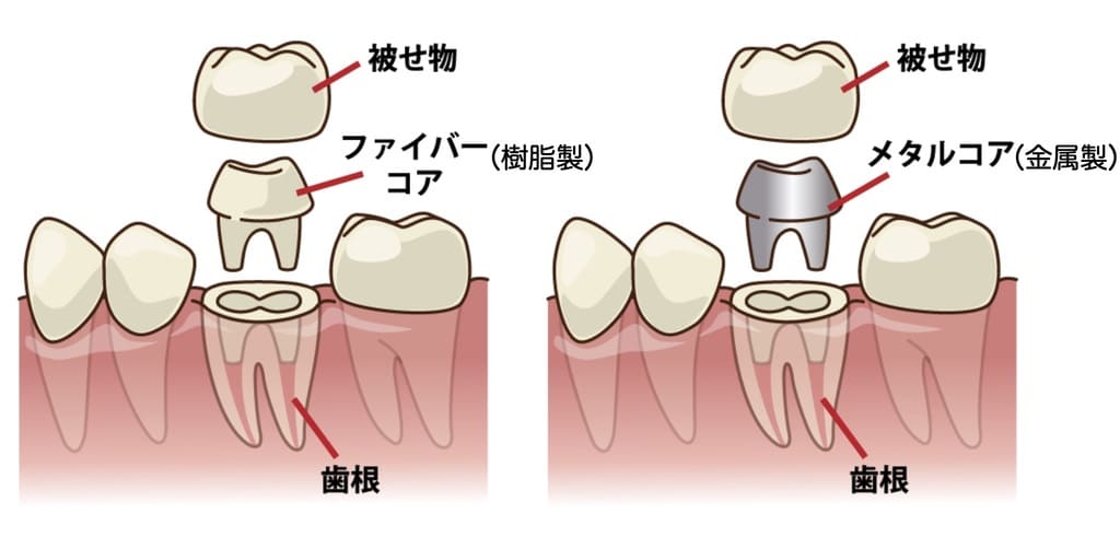 歯の土台の治療を示す画像