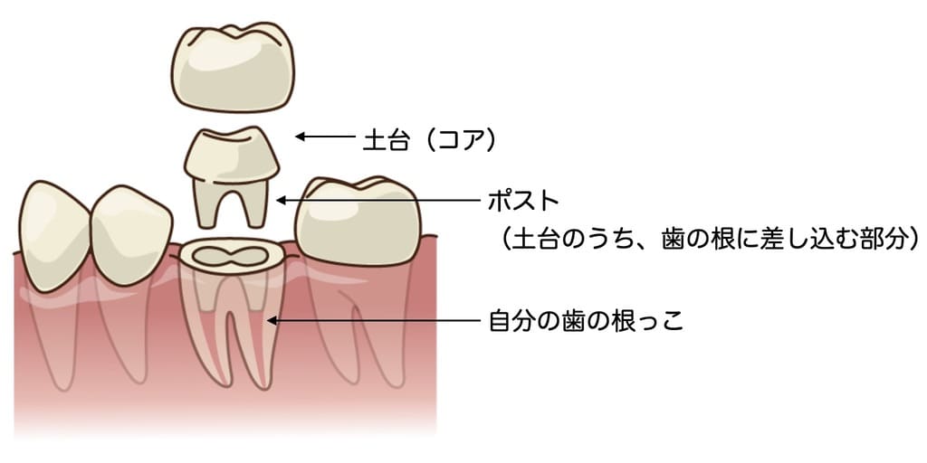 差し歯の土台の説明の画像