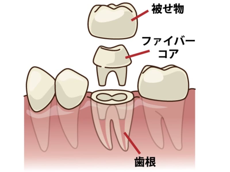 歯の土台の画像