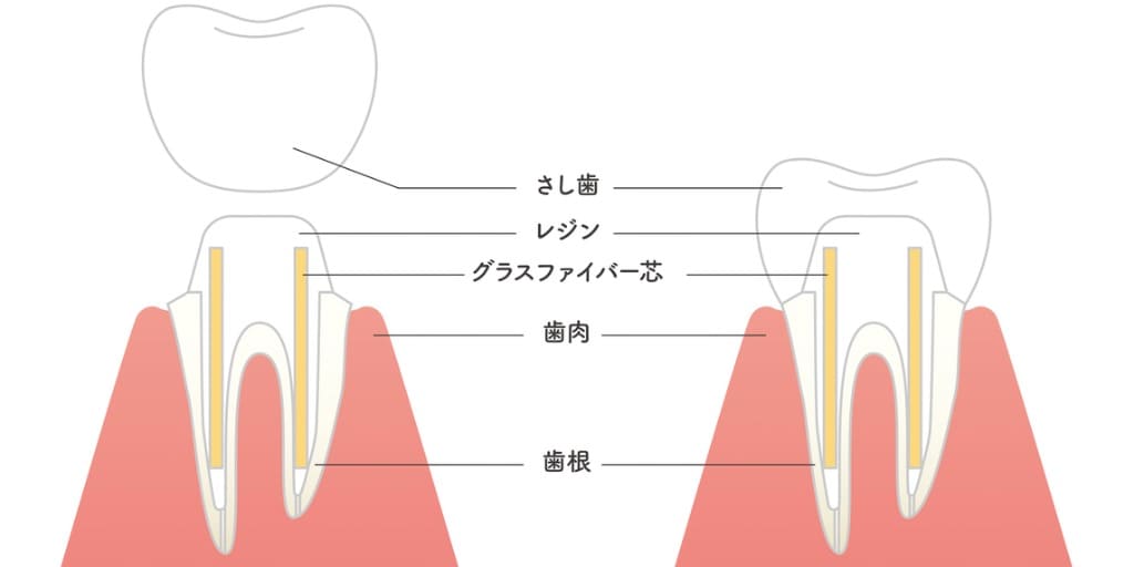 歯の土台の断面図の画像