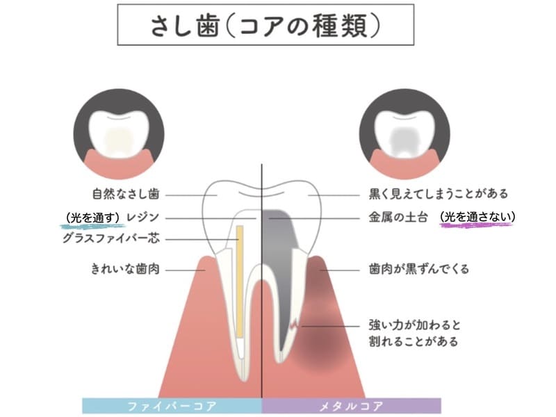 ファイバーコアとメタルコアの透過性の違いを示す画像