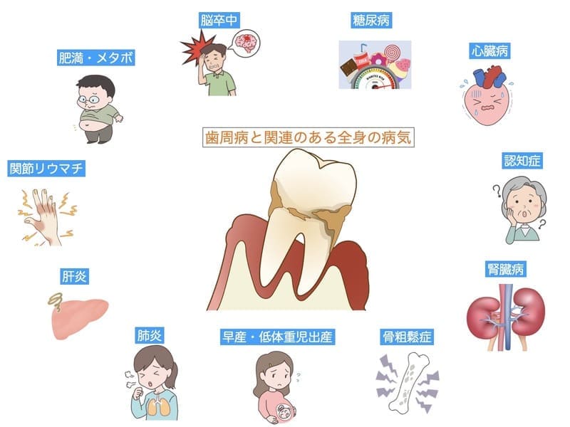 歯周病と全身の病気の関連を示す画像