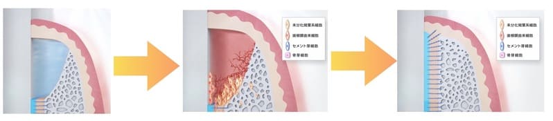 歯槽骨の再生を示す画像