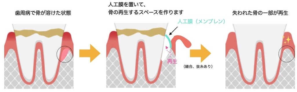 歯周組織再生療法（GTR法）の画像