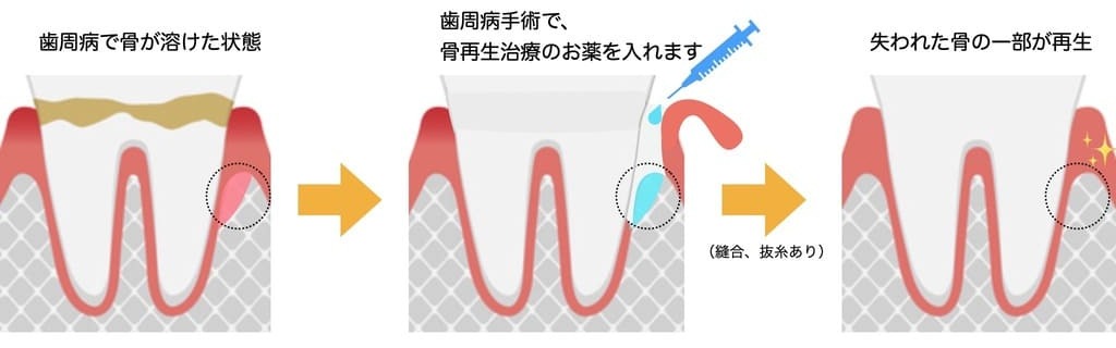 歯周組織再生療法（リグロス）の画像