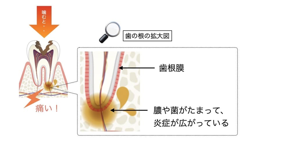 歯の根っこの炎症の画像