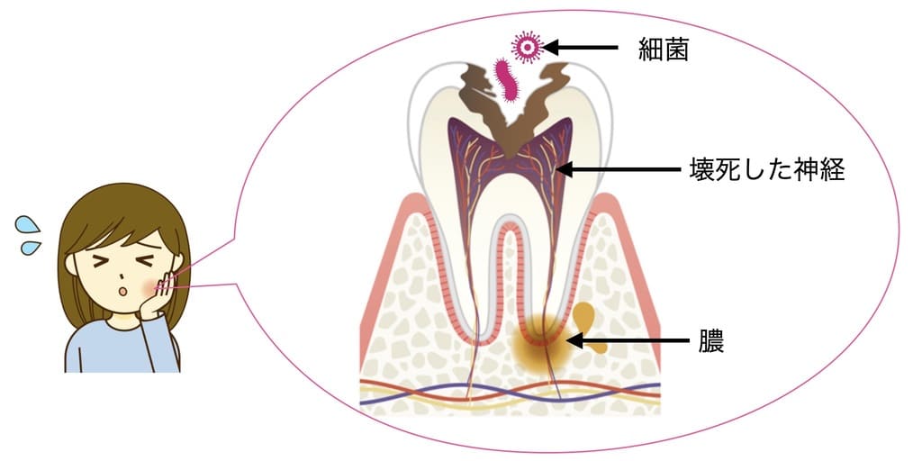 歯の根の膿の画像