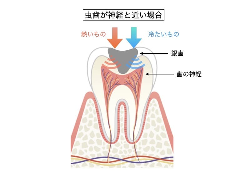 銀歯が原因で歯がしみる画像