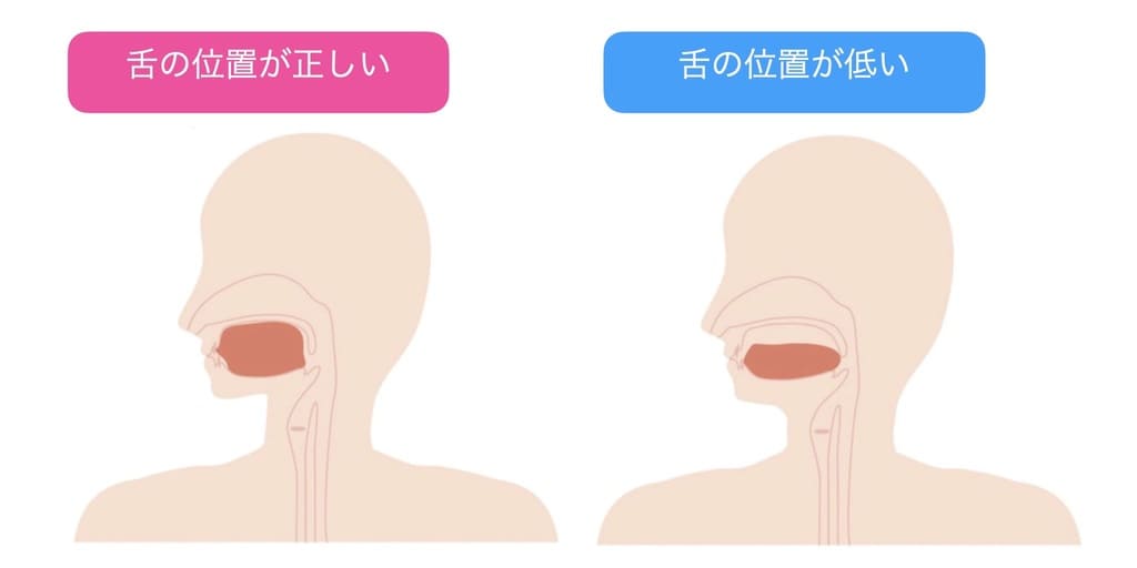 舌の正しい位置の画像