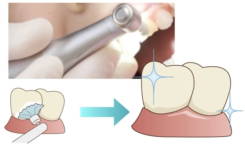 歯のクリーニングの画像