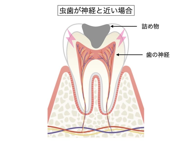 歯の神経が過敏になっている画像