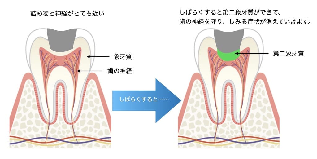 第二象牙質の画像