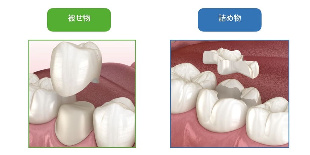 歯の詰め物や被せ物の画像