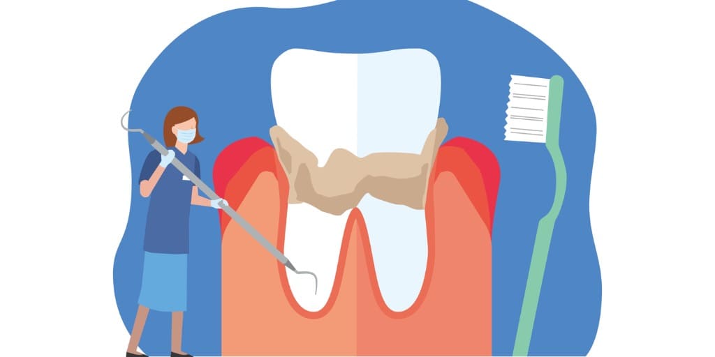 歯石取りをする歯科衛生士の画像