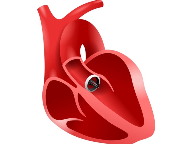 人工弁を設置した心臓のイラスト画像