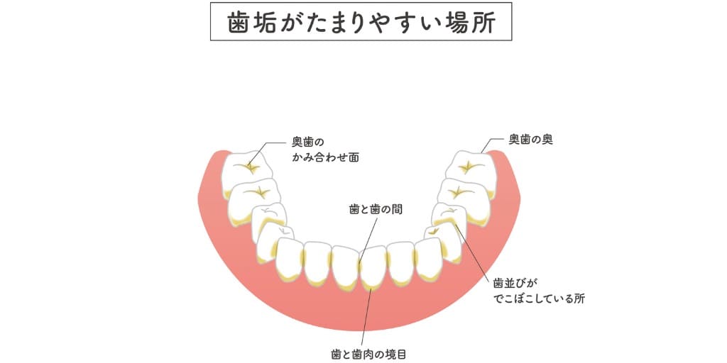 虫歯になりやすい場所の画像