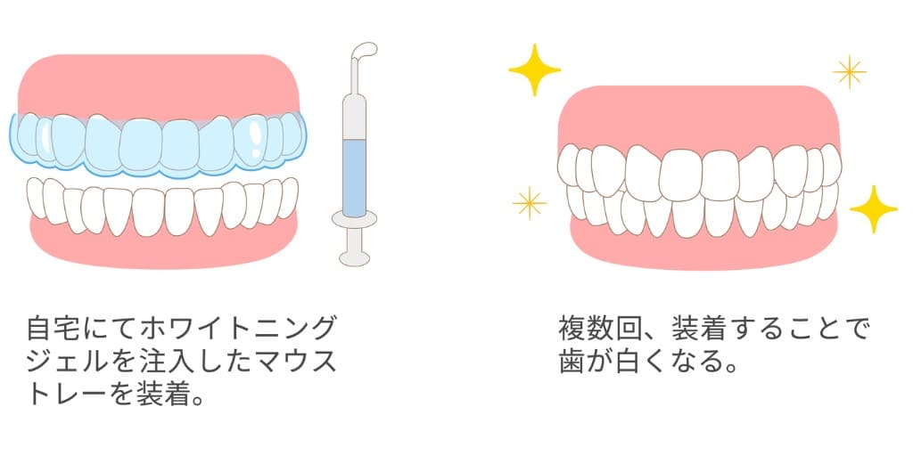 ホームホワイトニングの画像