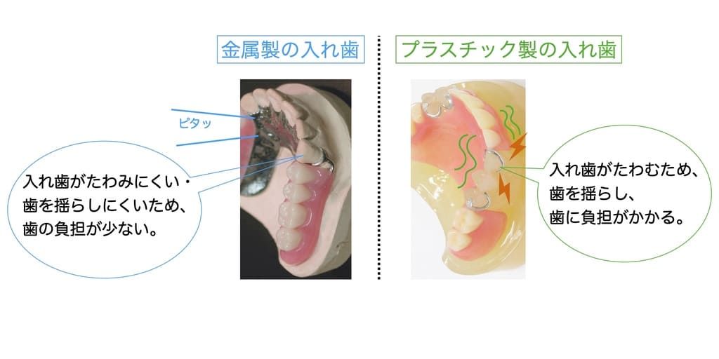 金属製入れ歯は歯の負担が少ないとする解説画像