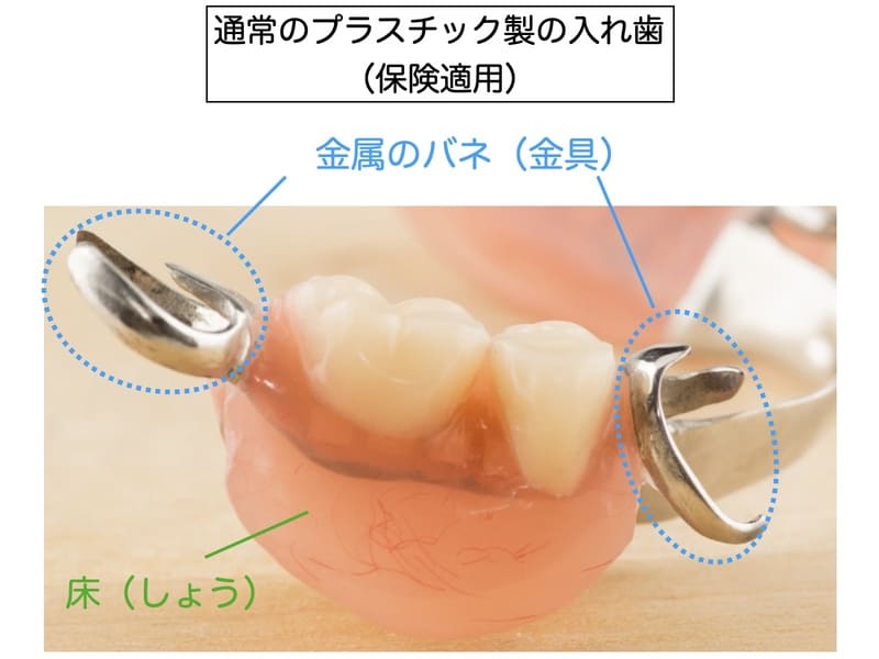 保険適用の部分入れ歯の画像
