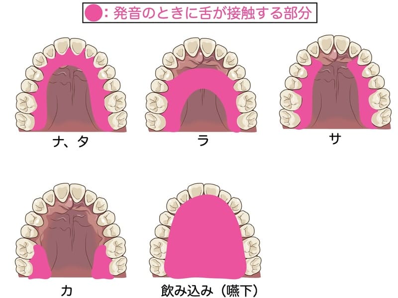 入れ歯と発音の関係を示すイラスト画像