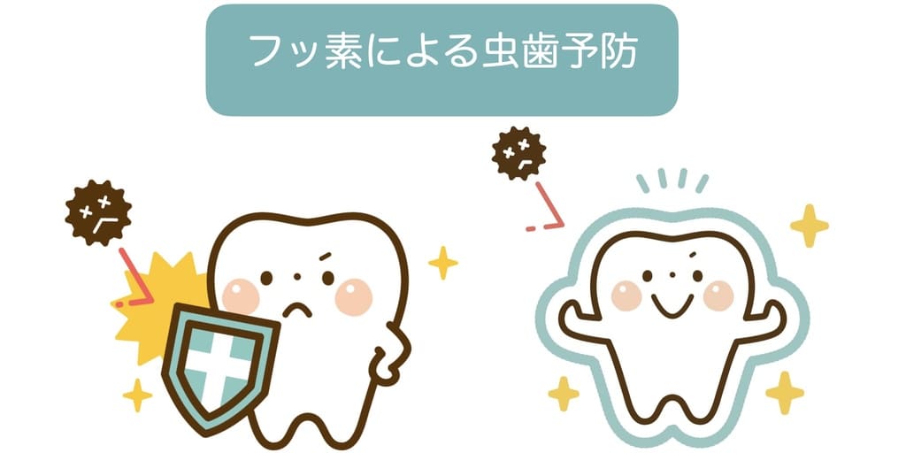 フッ素塗布の虫歯予防効果を示すイラスト画像