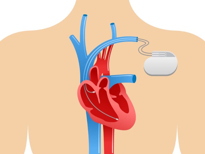 ペースメーカーと心臓の画像