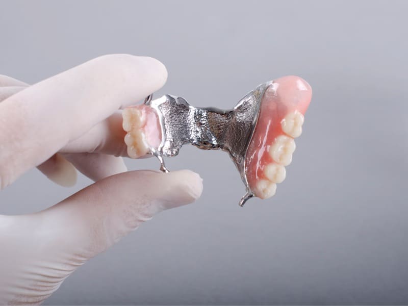 金属製の入れ歯の画像