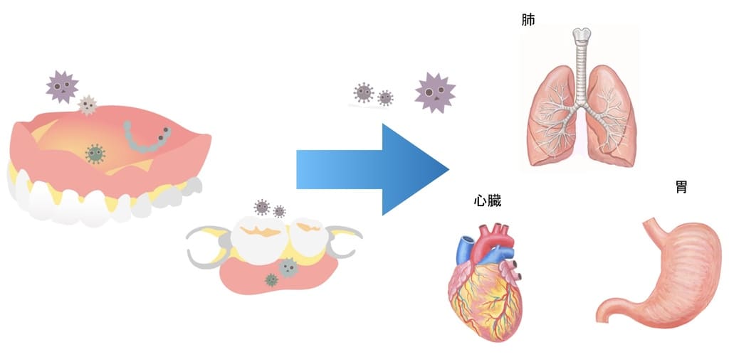 入れ歯についた細菌が臓器に与える影響を示す解説画像