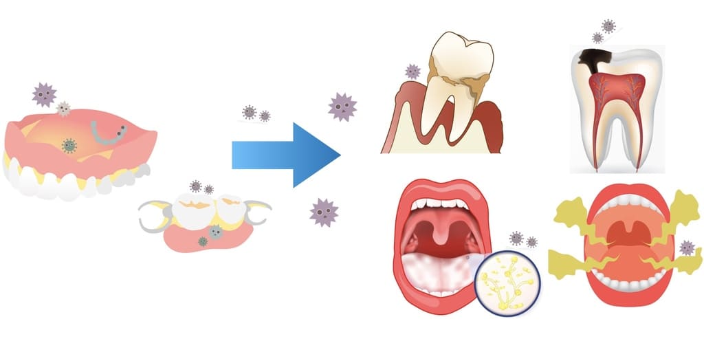 入れ歯の細菌が口の病気につながる解説画像