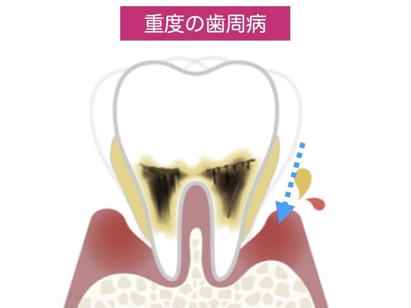 重度歯周病による細菌侵入の解説画像