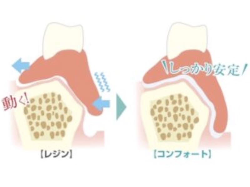 シリコン製入れ歯の利点（外れにくい）の画像