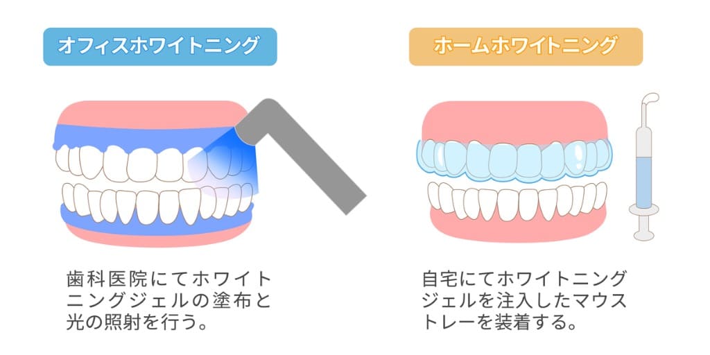 ホームホワイトニングとオフィスホワイトニングの違いの画像