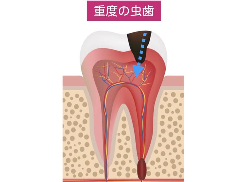 重度の虫歯による細菌侵入の解説画像