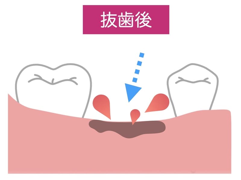 抜歯後の細菌の侵入の解説画像