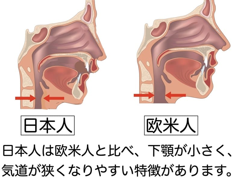 睡眠時無呼吸症候群になりやすい身体的特徴