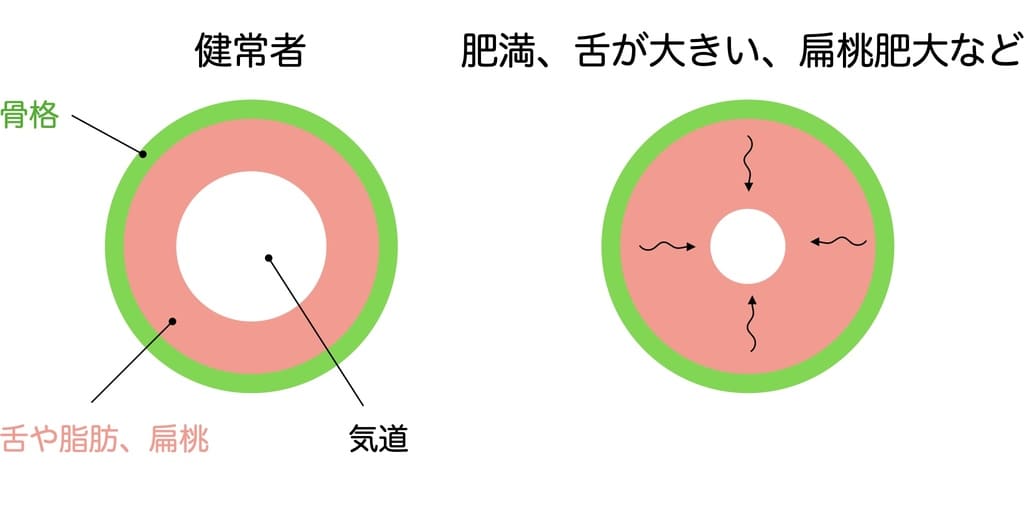 肥満で気道が狭くなる人の解説画像