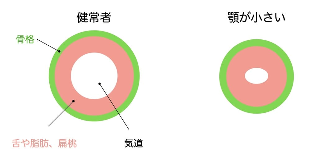 顎が小さいと気道が狭くなることを解説する画像