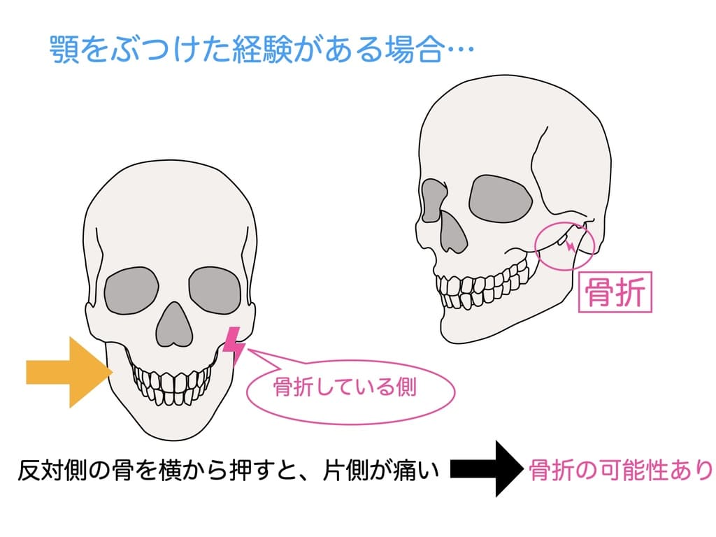 顎の骨折の画像