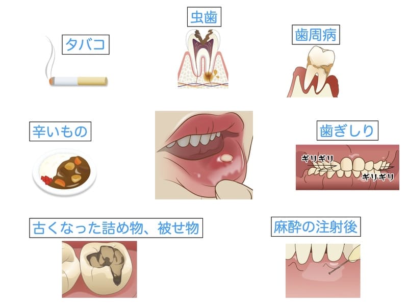 口の粘膜を傷つける原因になるものの画像