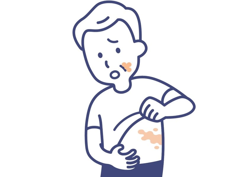 帯状疱疹で発疹が出る人のイラスト画像