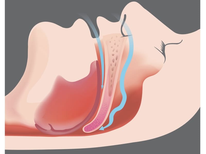 睡眠時無呼吸症候群の人の気道の解説画像