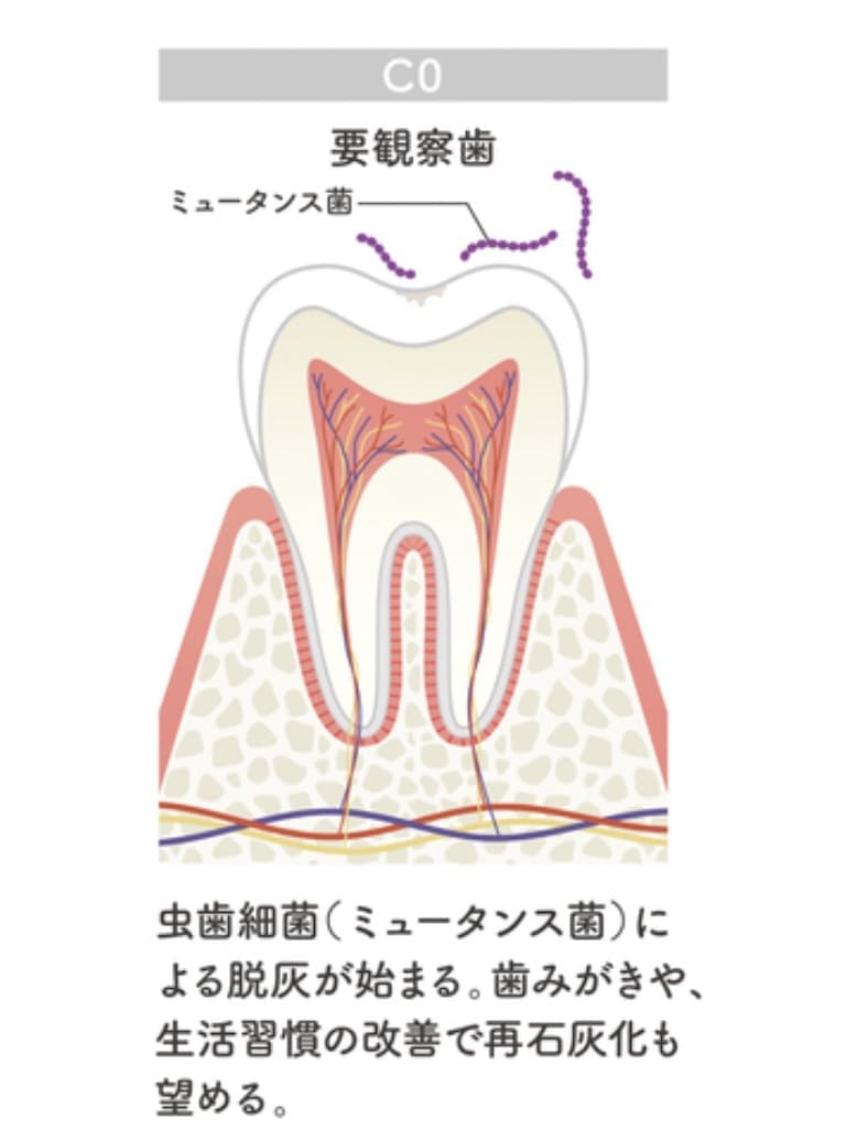 初期虫歯C0の画像